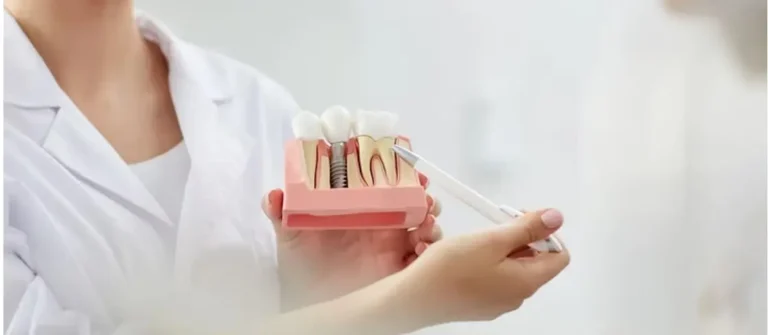 Dental Implant in Burgess Hill: Your Complete Guide